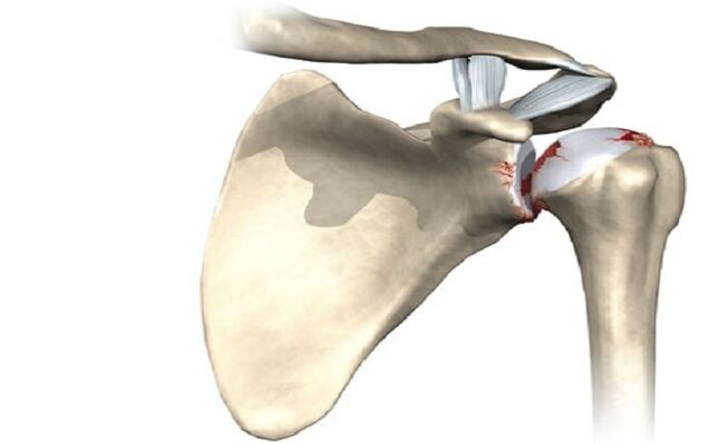 Травма плечевого сустава из-за остеоартрита